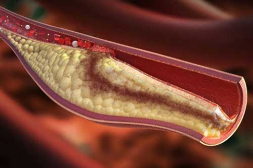 Uống 1 ly nước thần kỳ này giúp bạn “quét sạch” mỡ máu, huyết áp cao hiệu quả cấp tốc