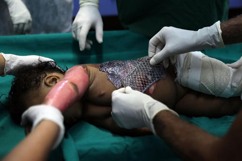 Cận cảnh cách chữa bỏng bằng da cá rô phi