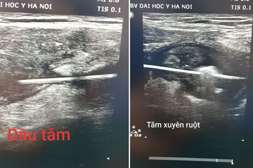 Hy hữu: Nuốt phải tăm... sau 2 tuần được lấy ra qua thành bụng