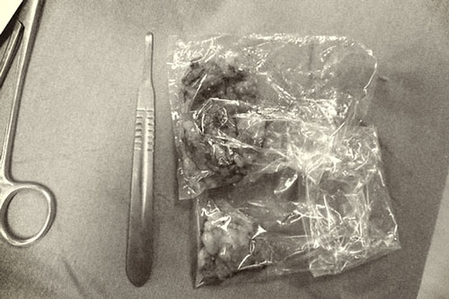 U mỡ: Lành tính nhưng chớ chủ quan vì những lý do này