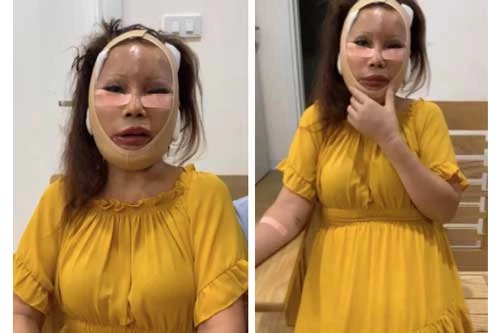 "Cô dâu 62 tuổi" khiến cư dân mạng "hú hồn" vì gương mặt biến dạng, sưng phù vì phẫu thuật thẩm mỹ