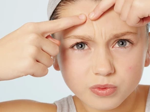 6 cách để mụn xẹp nhanh chóng