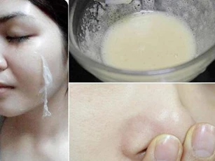 Đắp mặt nạ cả năm mụn đầu đen vẫn đeo bám, bạn phải cho thêm 1 muỗng thứ này