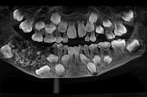 Hy hữu: Cậu bé 7 tuổi có đến 526 cấu trúc giống răng trong miệng