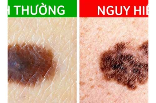 6 dấu hiệu nhận biết sớm nốt ruồi ác tính, nếu thấy mình có 1 biểu hiện cũng phải đi khám ngay