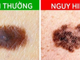 6 dấu hiệu nhận biết sớm nốt ruồi ác tính, nếu thấy mình có 1 biểu hiện cũng phải đi khám ngay