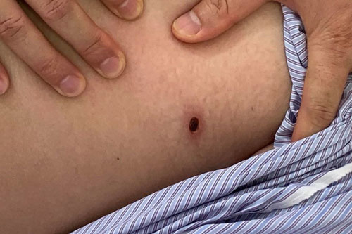 Cảnh báo gia tăng bệnh sốt mò trong mùa Hè