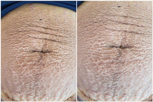 Bức ảnh bụng rạn "nhìn phát sợ" đang gây bão mạng xã hội và câu chuyện đau lòng phía sau