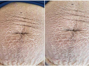 Bức ảnh bụng rạn "nhìn phát sợ" đang gây bão mạng xã hội và câu chuyện đau lòng phía sau