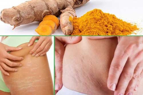 3 cách chữa rạn da sau sinh bằng nghệ, mẹ bầu nào cũng nên biết