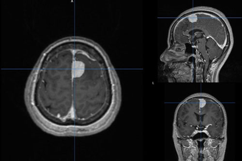 Đau đầu, chóng mặt nhiều năm liền, hóa ra do khối u não hành hạ