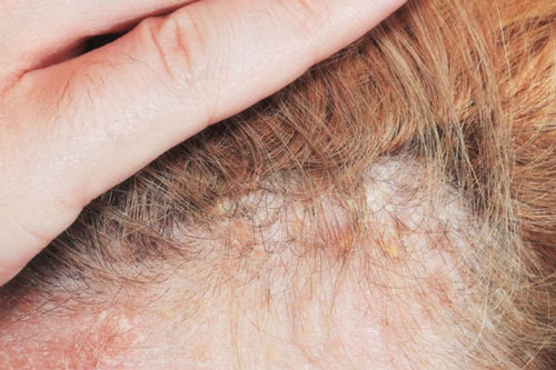 Những lưu ý khi vệ sinh da đầu cho bệnh nhân vảy nến