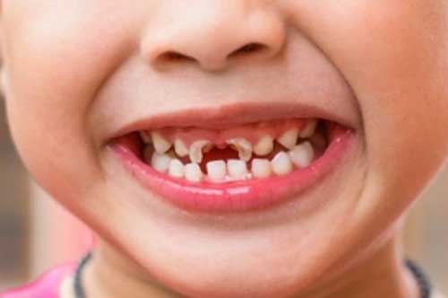 5 món ăn vặt hấp dẫn nhưng nằm trong danh sách "đen", ảnh hưởng đến men răng của trẻ