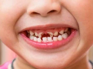 5 món ăn vặt hấp dẫn nhưng nằm trong danh sách "đen", ảnh hưởng đến men răng của trẻ