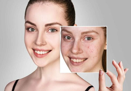 Mụn đầu đen, lỗ chân lông to, chỉ cần thực hiện ba bước đơn giản để có làn da láng mịn