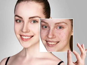 Mụn đầu đen, lỗ chân lông to, chỉ cần thực hiện ba bước đơn giản để có làn da láng mịn