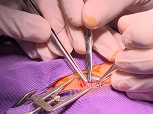 Lác mắt bẩm sinh ở trẻ - bệnh cần được điều trị sớm