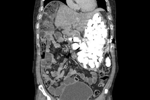Người đàn ông nuốt 2kg sỏi vào bụng để… giảm lo lắng