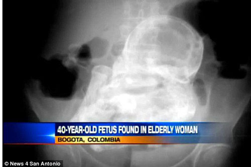 Bác sĩ ngỡ ngàng khi phát hiện thai nhi 44 năm tuổi trong bụng cụ bà 84 tuổi