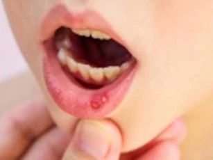 9 cách trị nhiệt miệng tại nhà đơn giản, hiệu quả