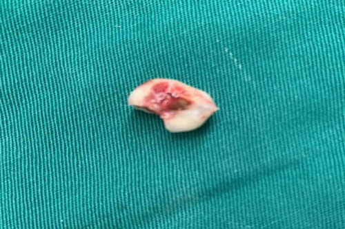 Đi nhổ răng sâu, bé gái bị răng rơi vào phế quản gây tắc đường thở