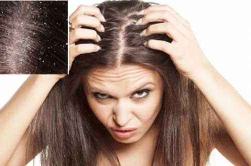 Dùng "thần dược" siêu rẻ này để gội đầu đảm bảo hết sạch 90% gàu trong lần gội đầu tiên