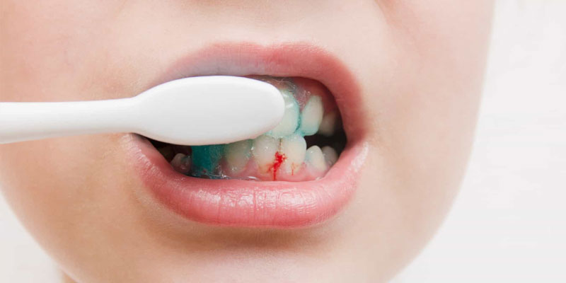 Chảy máu chân răng: Dấu hiệu cảnh báo nhiều bệnh nguy hiểm