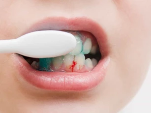 Chảy máu chân răng: Dấu hiệu cảnh báo nhiều bệnh nguy hiểm