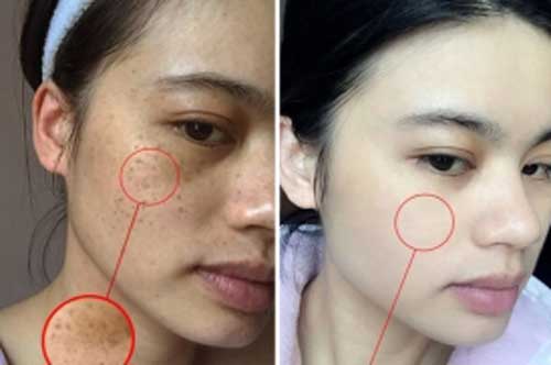 Cứ ầm ầm trị nám bằng công nghệ mà chị em quên rằng tinh dầu dừa trị nám rất tốt nhưng ít người biết