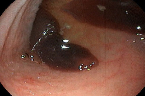 Bác sĩ "bó tay" vì ổ sán lá ruột quá nhiều gắp mãi không hết