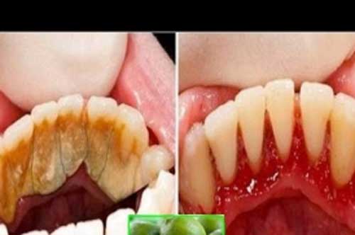 Cho thứ này vào miệng 2 phút trước đi ngủ, cao răng tróc ra từng mảng, hôi miệng kinh niên cũng đầu hàng