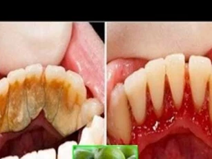 Cho thứ này vào miệng 2 phút trước đi ngủ, cao răng tróc ra từng mảng, hôi miệng kinh niên cũng đầu hàng