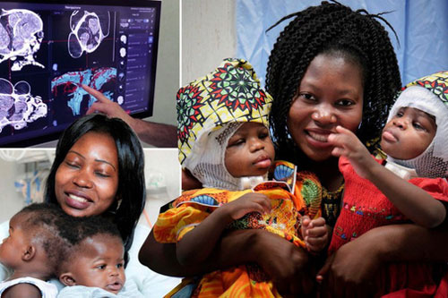 Tách thành công cặp song sinh 2 tuổi dính liền đầu