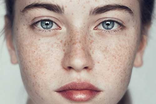 Đây là những nguyên nhân gây ra tàn nhang, nám da ở phụ nữ và cách phòng ngừa