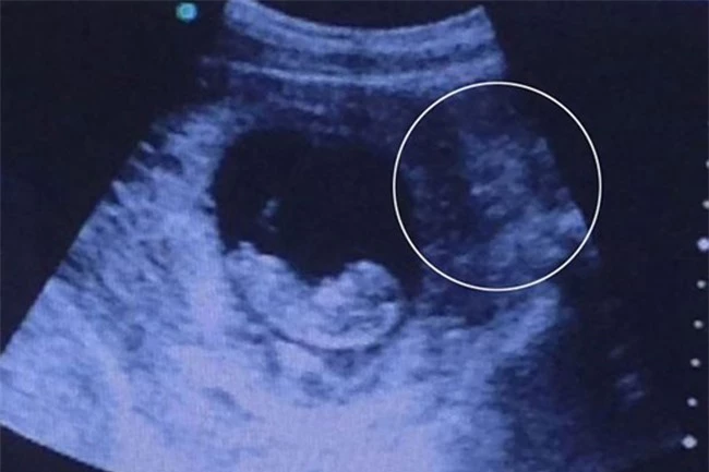 Những hình ảnh siêu âm thai khiến người xem ‘lạnh gáy’ - 3