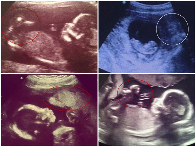 Những hình ảnh siêu âm thai khiến người xem "lạnh gáy"