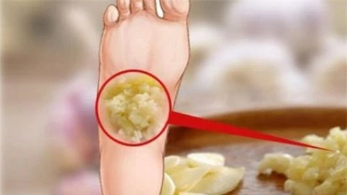 Thường xuyên đắp tỏi vào lòng bàn chân tác dụng gì