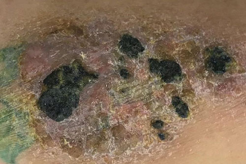 Những lưu ý khi chăm sóc hình xăm trên da