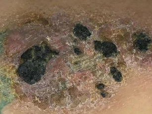 Những lưu ý khi chăm sóc hình xăm trên da