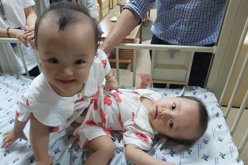 Hai bé gái song sinh dính nhau Trúc Nhi - Diệu Nhi. (Ảnh: Bệnh viện Nhi đồng Thành phố)