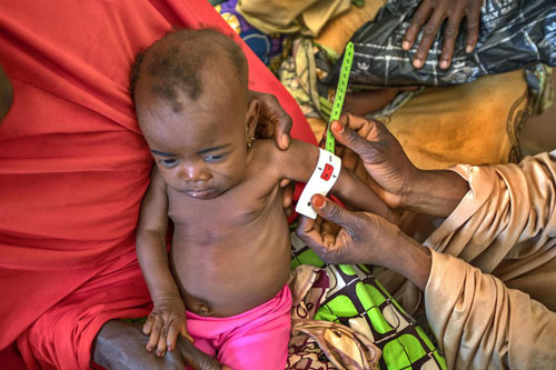 Suy dinh dưỡng gây thiệt hại lên tới 850 tỷ USD tại các nước đang phát triển