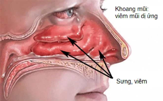 Để nhanh chóng thoát khỏi phiền toái do viêm mũi dị ứng gây ra, người bệnh phải tránh xa những món ăn dưới đây