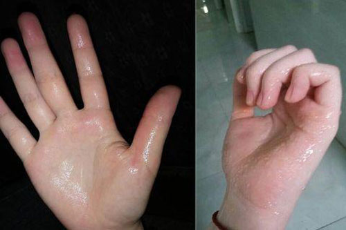 Những khu vực này đổ mồ hôi cho thấy cơ thể đang gặp vấn đề, đừng nghĩ do nóng