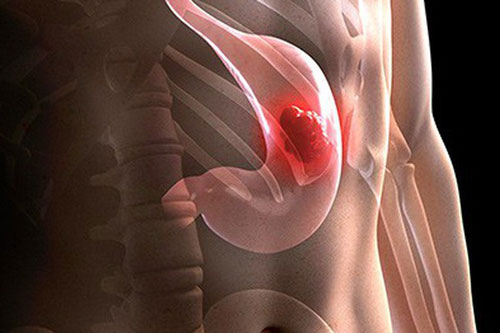 5 đối tượng có nguy cơ cao mắc ung thư dạ dày