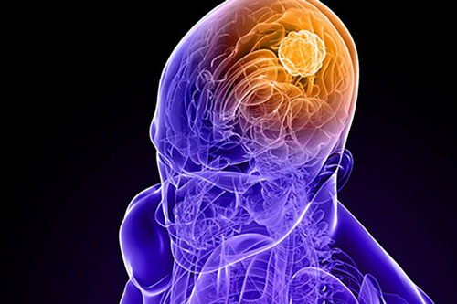 Ung thư não là căn bệnh như thế nào?