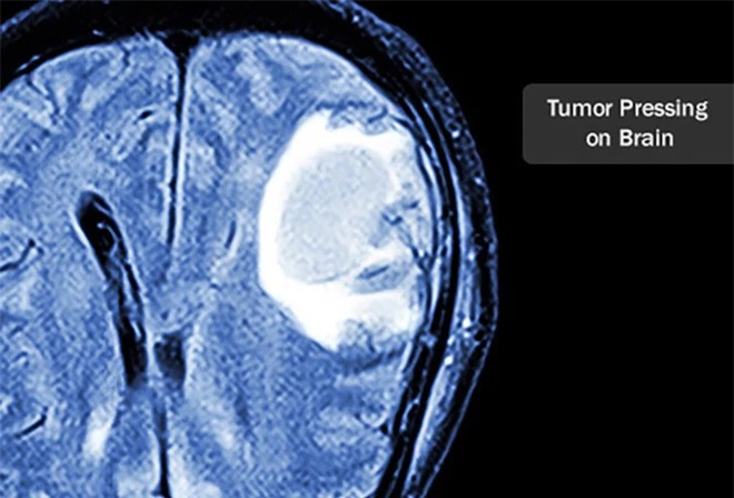 Ung thư não là căn bệnh như thế nào? - Ảnh 2.