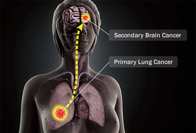 Ung thư não là căn bệnh như thế nào? - Ảnh 3.