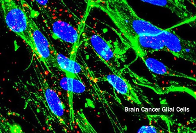 Ung thư não là căn bệnh như thế nào? - Ảnh 4.