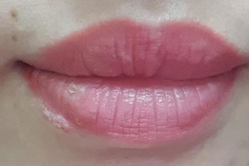 Nổi ban đỏ toàn thân do nhiễm herpes khi xăm môi