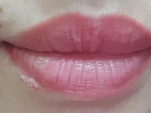 Nổi ban đỏ toàn thân do nhiễm herpes khi xăm môi